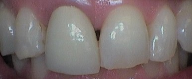 Before treatment: upper front teeth with uneven edges and small gaps