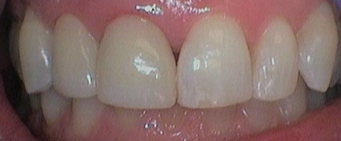 After treatment: evenly shaped, aligned upper front teeth with the gaps closed