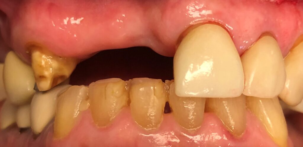 Before treatment: missing upper front teeth and worn, discolored remaining teeth