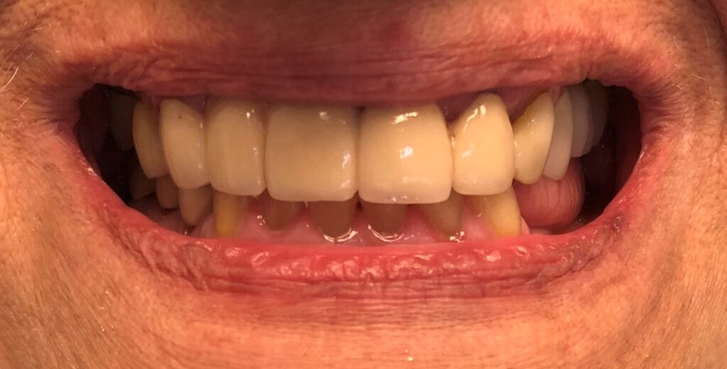 After treatment: a complete, even row of restored upper teeth